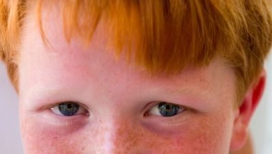 Life is painful for Redheads… and there could be scientific evidence to prove it