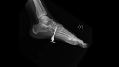 Video: That’s one way to get a key stuck in your foot