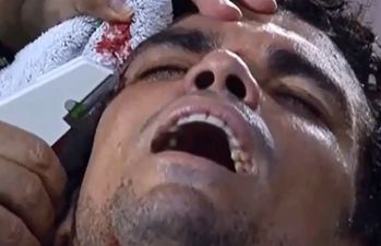 Video: Pepe had a nasty face wound stapled shut on the pitch last night (Warning: Graphic Content)