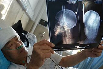 Pic: Man in China fails to recognise knife sticking out of his head after it falls from high-rise apartment