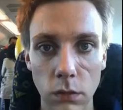 Video: Irish guy makes amazing timelapse of his recovery from plastic surgery after unprovoked drunken assault