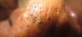 Video:  This disgusting video of zit-popping is so bad we can’t even look away