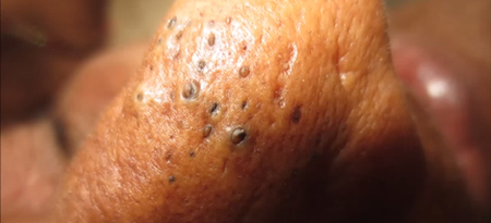 Video:  This disgusting video of zit-popping is so bad we can’t even look away