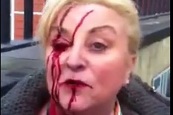 Video: Water charges protestor sustains nasty-looking facial injuries in Dublin (NSFW)