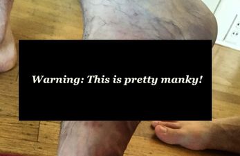 Pic: A screw popped out of this man’s foot, and it’s fairly disgusting