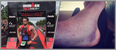 This is how Bressie went from dislocating his ankle to completing Ironman Dublin in just 8 weeks