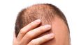 PIC: Men should avoid this one particular hairstyle because it makes you go bald