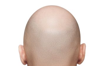 JOE BLOGS: 5 things I’ve learned from my year with alopecia