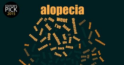 Dealing with alopecia: A JOE writer tells his story