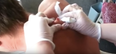 VIDEO: This guy’s 30-year-old cyst being popped is even more disgusting than you’d imagine