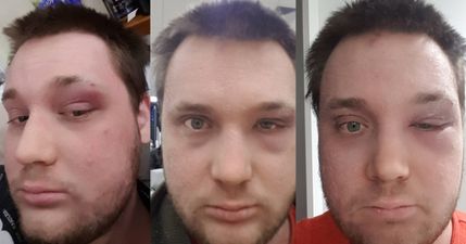 PICS: Man shares horrifying story of what happened when he tried to pop a pimple