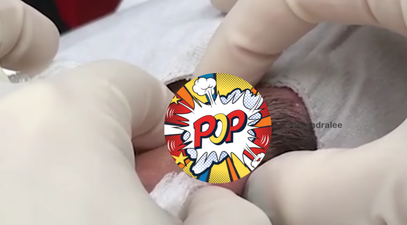 WATCH: Dr Pimple Popper’s latest spot popping video could be her worst one yet (Graphic)
