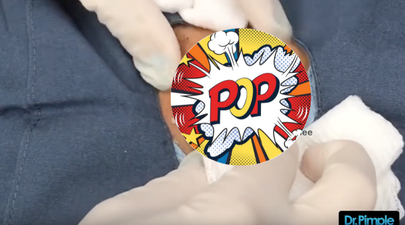 WATCH: This cyst popping video is definitely not for the faint-hearted