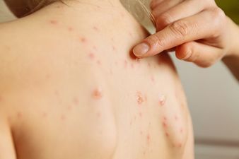 Warning issued by the HSE following measles outbreak