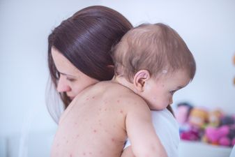 HSE issue health warning over measles outbreak