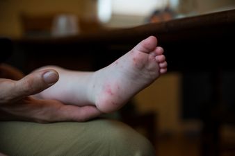 At least four children have been hospitalised with ”highly contagious” Hand, Foot and Mouth disease