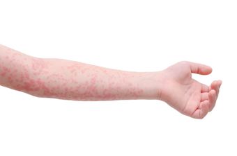 An outbreak of measles has been confirmed in Limerick