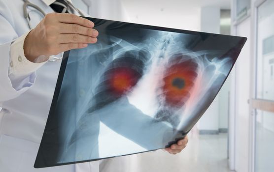 lung cancer screening ireland