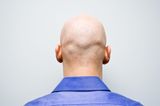 Calling men bald is now sex harassment, judge rules