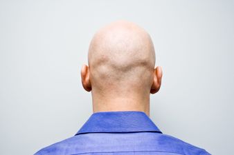 Calling men bald is now sex harassment, judge rules