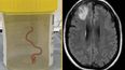 Live worm found in woman’s brain in world first discovery
