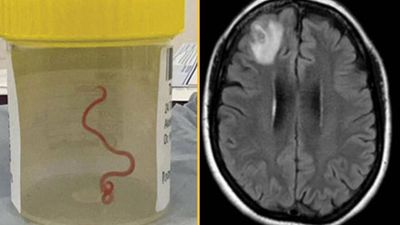 Live worm found in woman’s brain in world first discovery