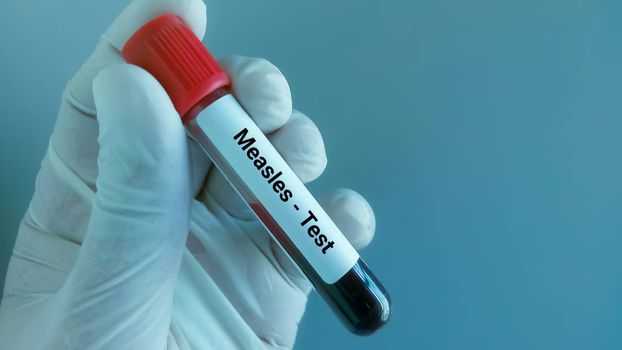 Measles Ireland flight